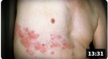 Screenshot 3herpes in isra